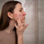 Top 7 Expert Tips and Strategies for Facial Redness Reduction Expert Tips and Strategies for Facial Redness Reduction